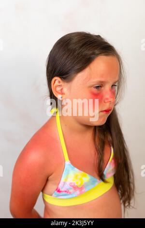 Sad little girl stand half turn with severe red burns on face and body after spending time in sun. Child in yellow swimsuit suffer from pain on Stock Photo