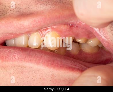 Ground prepared teeth before installing a porcelain fused-to-metal crown for decayed teeth. Prosthetics in dentistry Stock Photo