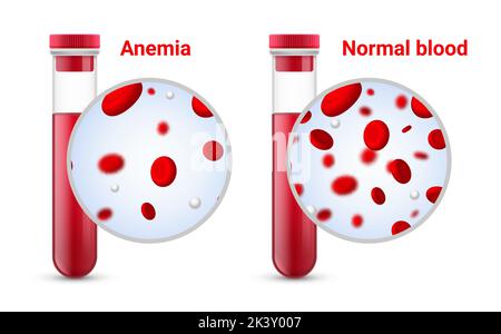 Anemia problem circulatory iron body diagram background. Anaemia biology blood isolated medical normal icon. Stock Vector