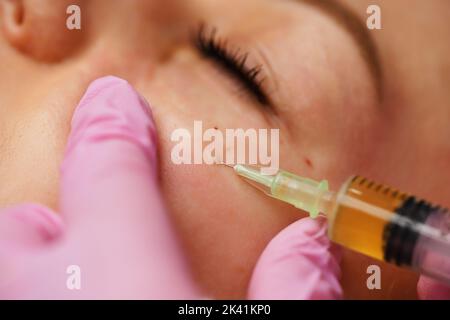 Blood plasma injections in the eye area Stock Photo - Alamy