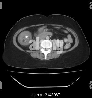 Intussusception of the intestines, CT scan Stock Photo
