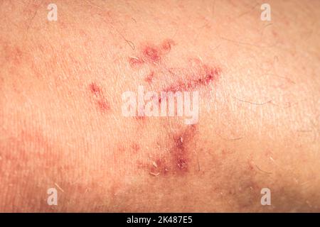 Crush injury scarring to leg - Stock Image - C038/1711 - Science