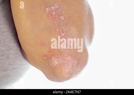 Psoriasis on elbows .Close up autoimmune incurable dermatological skin disease psoriasis. Inflamed, flaky rash on elbows. Joints affected by psoriatic Stock Photo