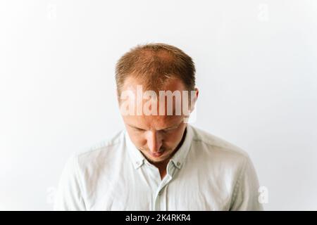 Before hair transplantation. Young bald man with hair loss problems. White background with copy space. Stock Photo