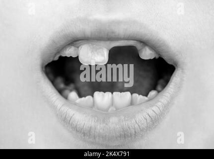 Close up of unhealthy baby teeths. Kid patient open mouth showing cavities teeth decay. Black and white Stock Photo