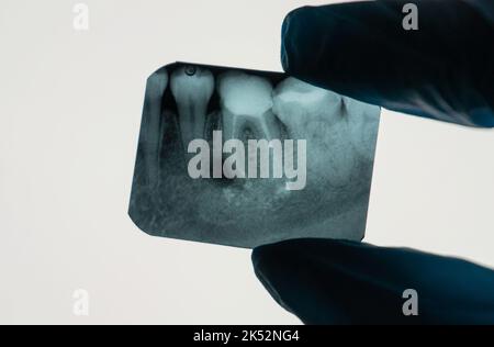 Periapical Dental Granuloma next to tooth root on an X-ray held by ...