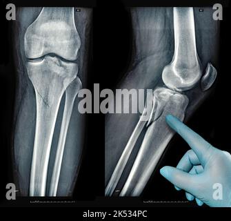 Xray images showing real fracture of broken leg bone under the knee after injury Stock Photo