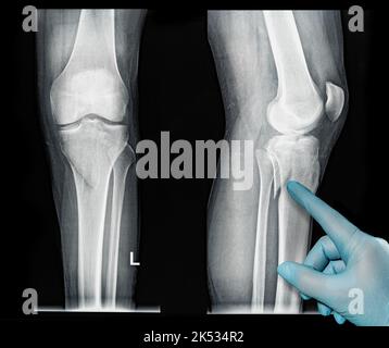 Xray MRI images showing real fracture of broken leg bone under the knee after injury medical glove point out Stock Photo