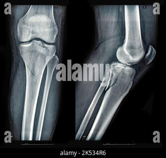 Xray images showing real fracture of broken leg bone under the knee after injury Stock Photo