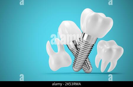 Dental Implants Complications | Cosmetic Dentist | Dental Implants London