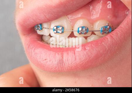 orthodontist braces blue