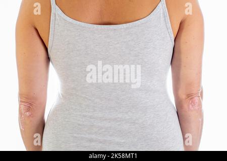 Psoriasis on elbows .Unrecognizable young woman suffering from autoimmune incurable dermatological skin disease psoriasis. Inflamed, flaky rash on Stock Photo
