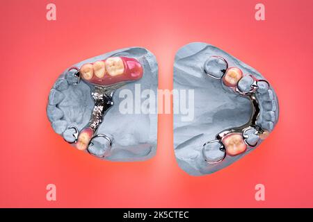 Dentures, partial dentures on plaster model Stock Photo