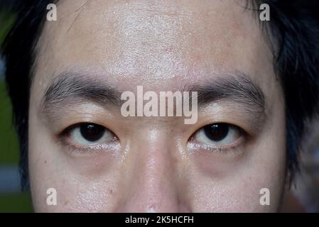 Excessive sweating or hyperhidrosis and oily skin at face of Southeast Asian, adult young man. Oily skin is the result of overproduction of sebum from Stock Photo