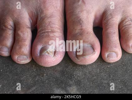 Damaged and cracked toenail. Fungal nail infection. Onychomycosis