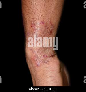 Fungal infection called tinea corporis in forearm of Southeast Asian man. Stock Photo