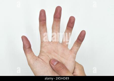 Cyanotic Hands Or Peripheral Cyanosis Or Blue Hands At Southeast Asian ...