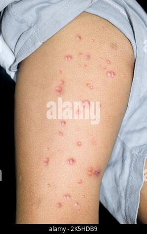 Monkeypox lesions in the thigh of Asian, Burmese Child. Stock Photo