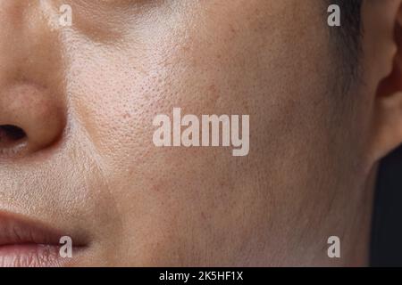 Fair skin with wide pores in face of Southeast Asian, Myanmar or Korean adult young man. Stock Photo