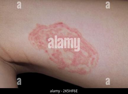 Fungal infection called tinea corporis in thigh of Southeast Asian child. Ringworm Stock Photo