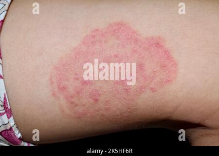 Fungal infection called tinea corporis in thigh of Southeast Asian child. Ringworm Stock Photo