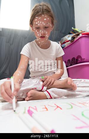 Little school girl with chickenpox drawing on white board in kids' room, antiseptic cream applied to face and body. Chalkboard and toys background.  Stock Photo