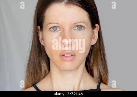 The face of a young girl is divided into two halves with and without face retouching with seven pimples and redness, before and after face treatment Stock Photo