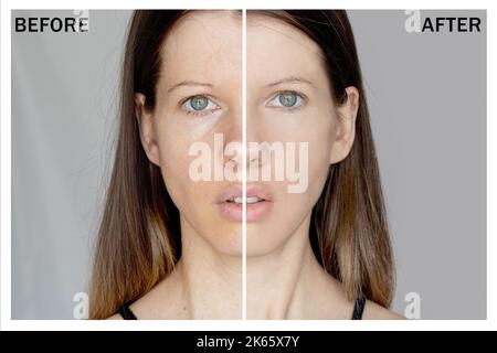 The face of a young girl is divided into two halves with and without face retouching with seven pimples and redness, before and after face Stock Photo