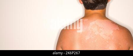 The delicate skin of an 11-year-old child burned by the sun. Concept of damage from ultraviolet rays of the sun. Effect of UVA and UVB rays. Stock Photo