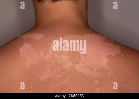 The delicate skin of an 11-year-old child burned by the sun. Concept of damage from ultraviolet rays of the sun. Effect of UVA and UVB rays. Stock Photo