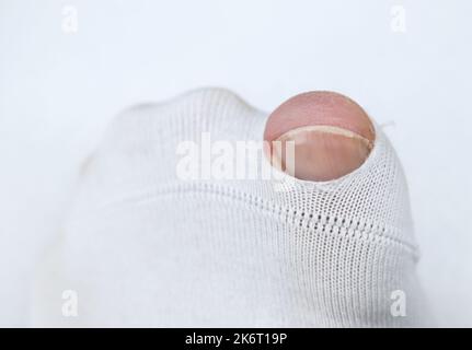 Toe visible through hole in white sock Stock Photo