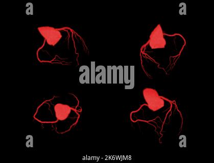 Collection of CT Cardiac 3D or CTA coronary artery for Check up coronary artery diseases. Stock Photo