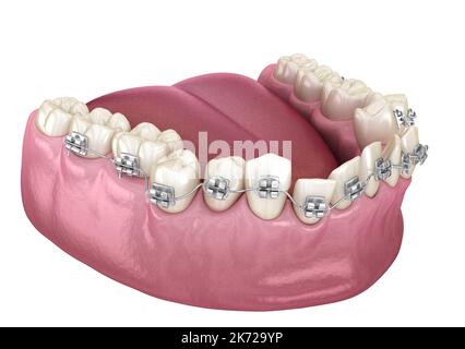Abnormal teeth position and Clear braces tretament. Medically accurate dental 3D illustration Stock Photo