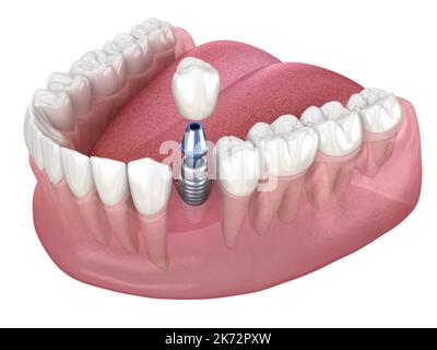 Premolar tooth recovery with implant. Medically accurate 3D illustration of human teeth and dentures concept Stock Photo