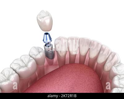 Premolar tooth recovery with implant. Medically accurate 3D illustration of human teeth and dentures concept Stock Photo