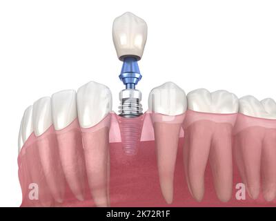 Premolar tooth recovery with implant. Medically accurate 3D illustration of human teeth and dentures concept Stock Photo