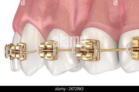 Golden braces tretament, macro view. Medically accurate dental 3D illustration Stock Photo