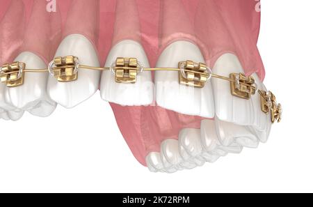 Golden braces tretament, macro view. Medically accurate dental 3D illustration Stock Photo