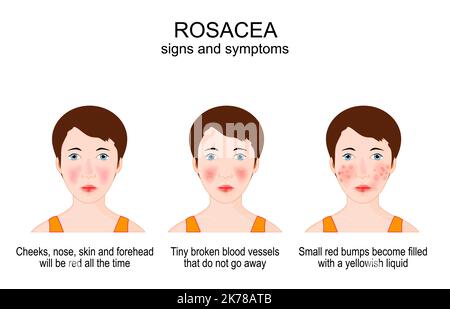 Rosacea. signs and symptoms of Acne rosacea on the face of a young woman. skin condition from redness, pimples, swelling and Tiny broken blood vessels Stock Vector
