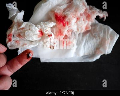 Top view Close up female Left ring finger was cut by knife, injured, bloody finger, The wound was coated with liquid gel plaster. With used crumpled t Stock Photo