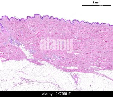 Light micrograph of thin skin showing from top to bottom, the epidermis, a very thick dermis showing sweat glands, and the adipose (fat) tissue of the hypodermis. Haematoxylin and eosin stain. The scale bar corresponds to 2 mm. Stock Photo