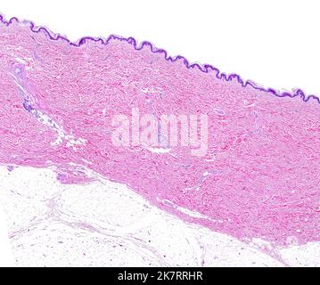 Light micrograph of thin skin showing from top to bottom, the epidermis, a very thick dermis showing sweat glands, and the adipose (fat) tissue of the hypodermis. Haematoxylin and eosin stain. Stock Photo