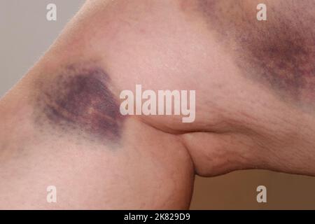 a large bruise on a person's leg. haematoma Stock Photo