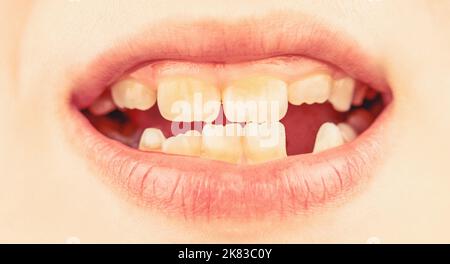 Child smile and show her crowding tooth. Close up of unhealthy baby teeths. Kid patient open mouth showing cavities teeth decay Stock Photo