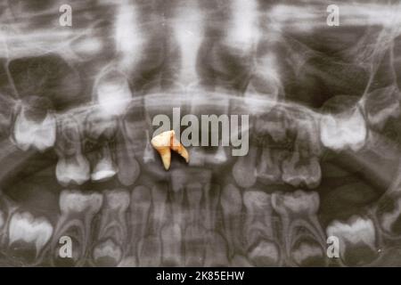 Embedded Tooth Panoramic A panoramic X-ray shows several embedded and impacted teeth on both the ...
