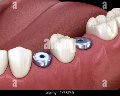 Temporary Implant abutments. Medically accurate 3D illustration of human teeth and dentures concept Stock Photo