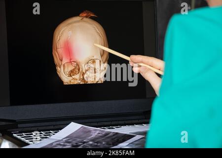 3D computed tomography of the brain with a fracture of the frontal part of the skull after injury on laptop screens on the table on laptop screens at Stock Photo