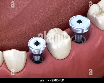 Temporary Implant abutments. Medically accurate 3D illustration of human teeth and dentures concept Stock Photo