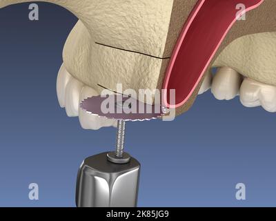 Sinus Lift Surgery - Creating side access to the Sinus. 3D illustration Stock Photo