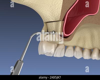 Sinus Lift Surgery - Moving sinus membrane. 3D illustration Stock Photo